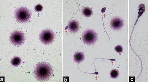 varikosel-hastaliginda-sperm-degisikligi