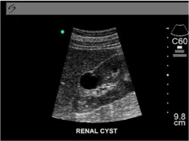 renal-cyst