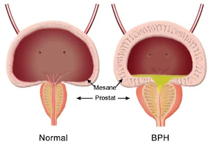 prostat-buyumesi