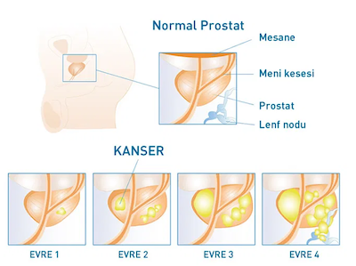 normal-prostat