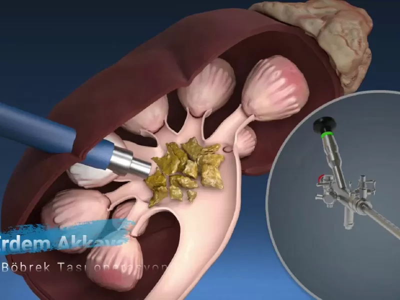 Kapalı böbrek taşı ameliyatı,perkutan nefrolittripsi,böbrek taşı kırma,böbrek taşı,böbrek taşı ameliyatı,perkütan nefrolitotomi